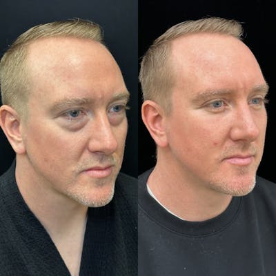 Lower Blepharoplasty Before & After Gallery - Patient 134836 - Image 2