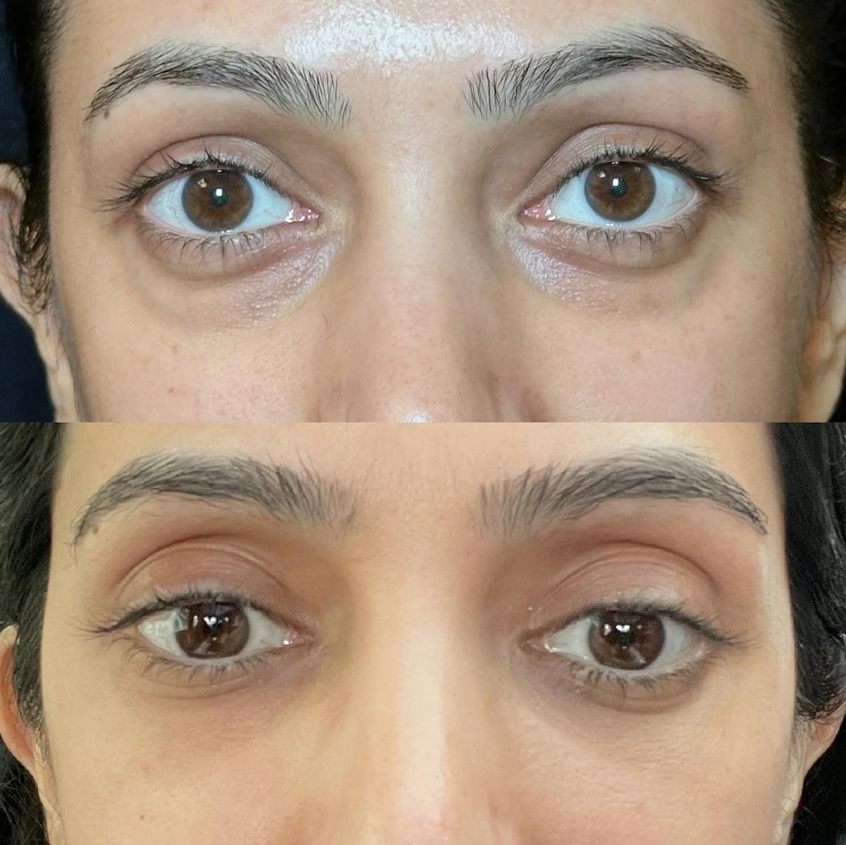 Lower Blepharoplasty Before & After Gallery - Patient 208097 - Image 1