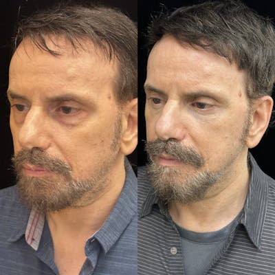 Lower Blepharoplasty Before & After Gallery - Patient 173740 - Image 3