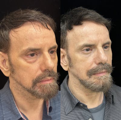 Lower Blepharoplasty Before & After Gallery - Patient 173740 - Image 2