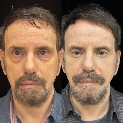 Lower Blepharoplasty Before & After Gallery - Patient 173740 - Image 1