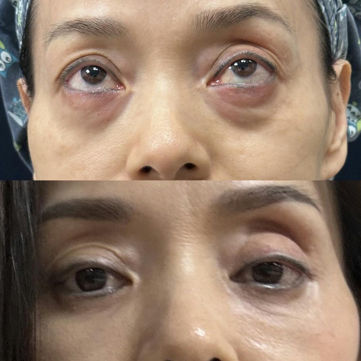 Lower Blepharoplasty Before & After Gallery - Patient 502876 - Image 1