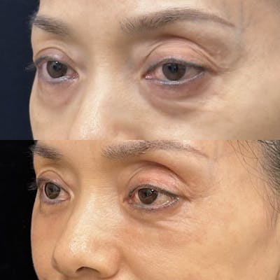 Lower Blepharoplasty Before & After Gallery - Patient 502876 - Image 3