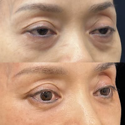 Lower Blepharoplasty Before & After Gallery - Patient 502876 - Image 2