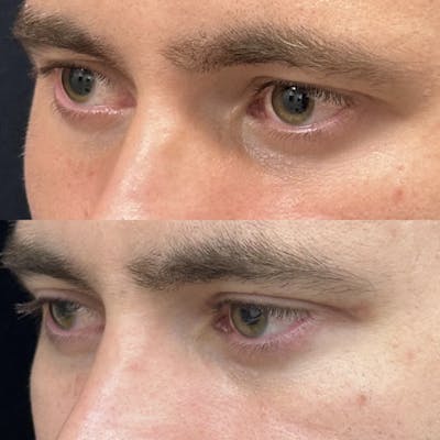 Upper Blepharoplasty Before & After Gallery - Patient 279990 - Image 3