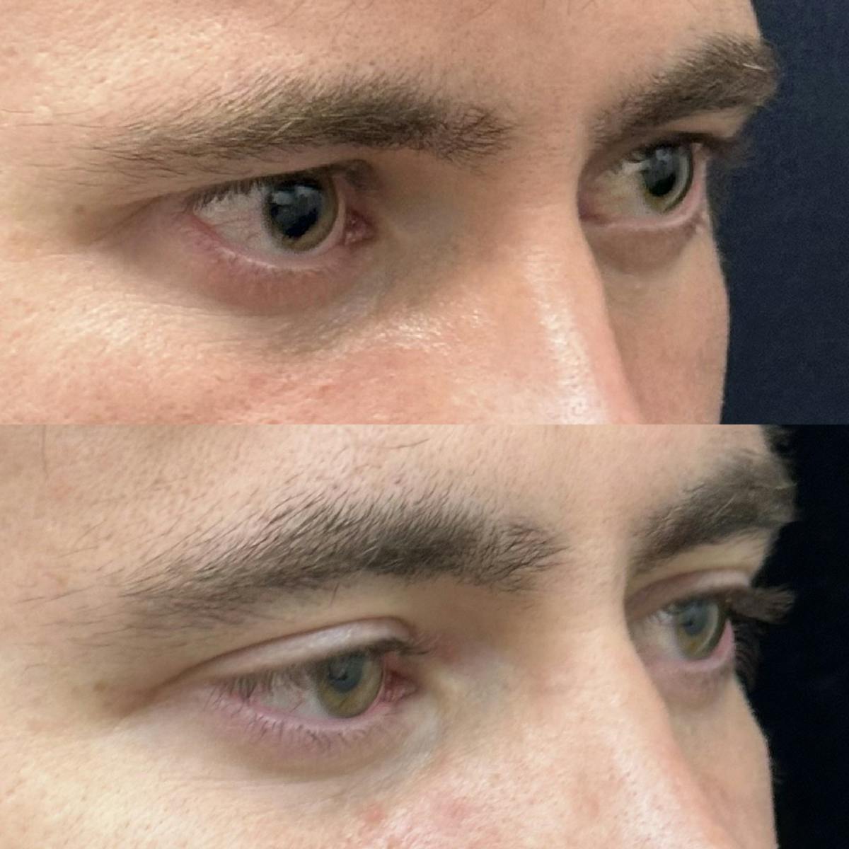  Upper Blepharoplasty Before & After Gallery - Patient 279990 - Image 2