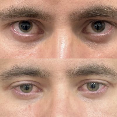 Upper Blepharoplasty Before & After Gallery - Patient 279990 - Image 1