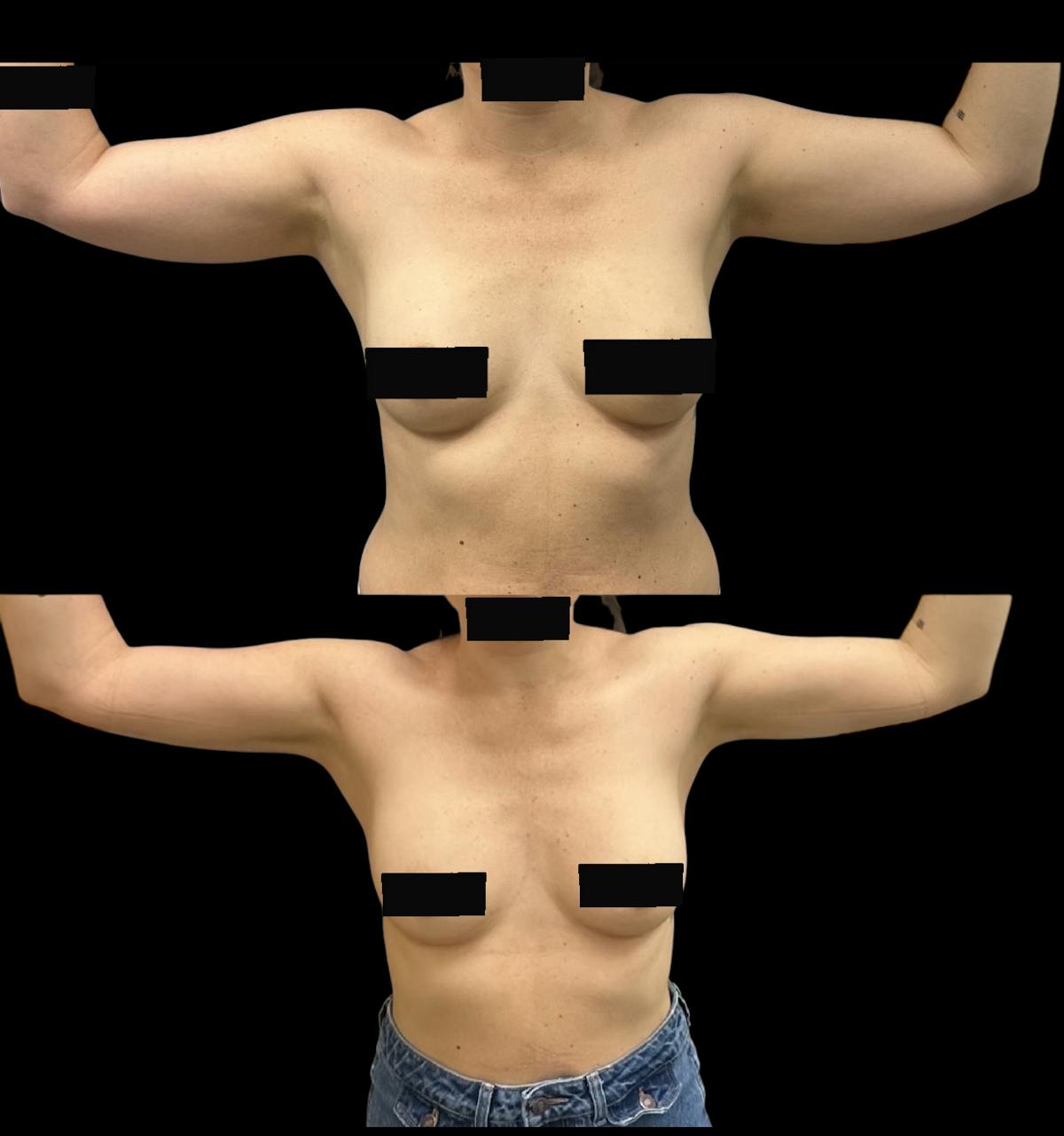 Arm Liposuction with Bodytite  Before & After Gallery - Patient 175364 - Image 2