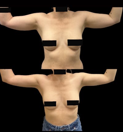 Arm Liposuction with Bodytite Before & After Gallery - Patient 175364 - Image 2