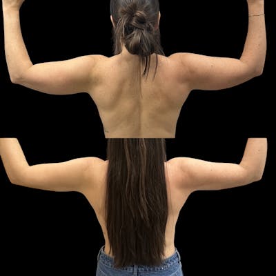 Arm Liposuction with Bodytite Before & After Gallery - Patient 175364 - Image 1