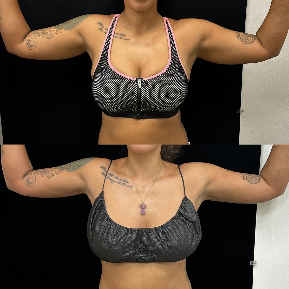 Arm Liposuction with Bodytite  Before & After Gallery - Patient 383994 - Image 1