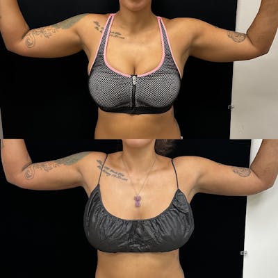Arm Liposuction with Bodytite Before & After Gallery - Patient 383994 - Image 1