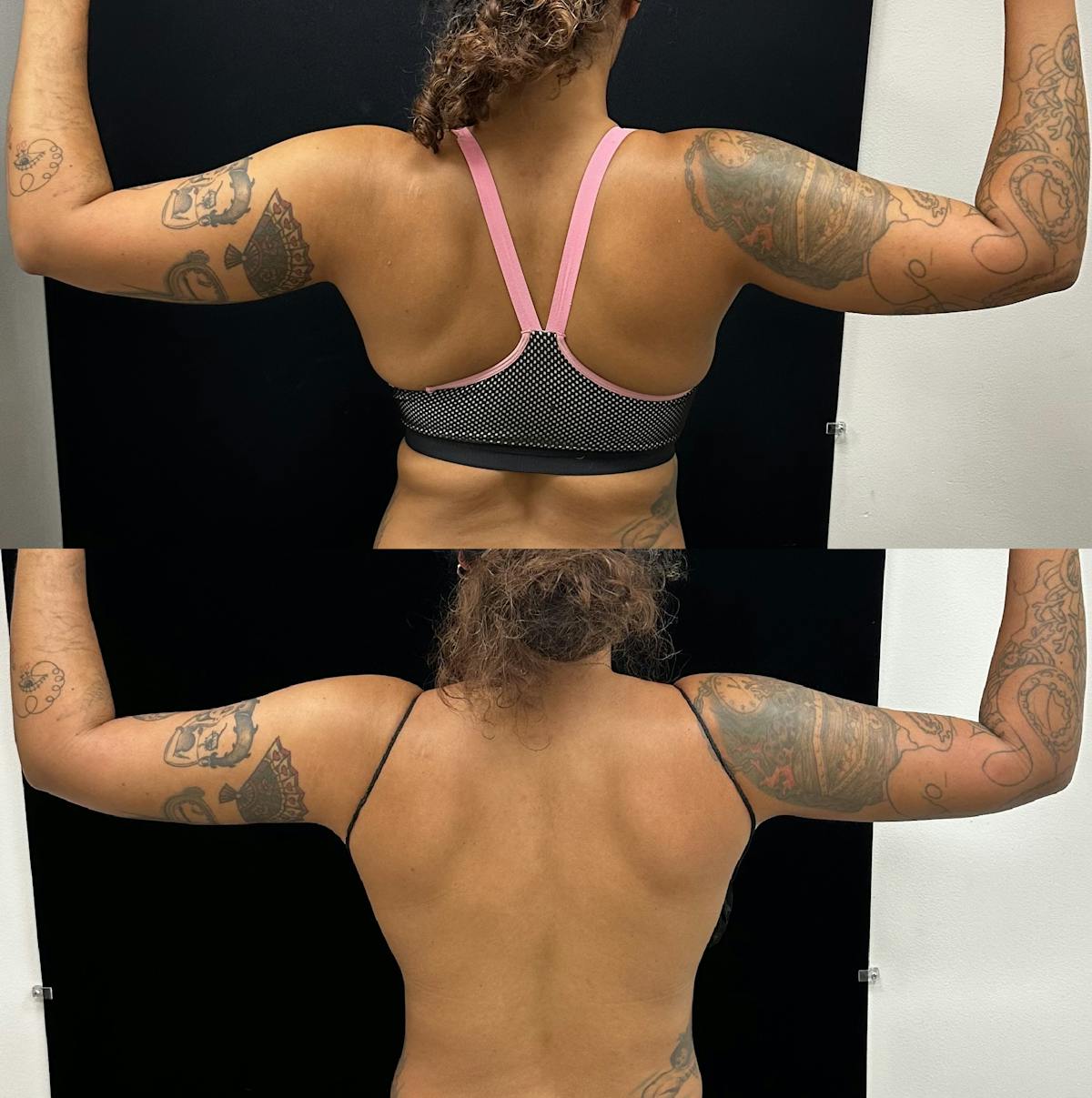 Arm Liposuction with Bodytite  Before & After Gallery - Patient 383994 - Image 2