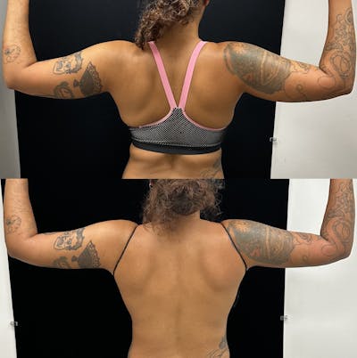 Arm Liposuction with Bodytite Before & After Gallery - Patient 383994 - Image 2