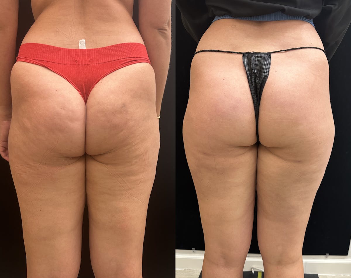 Aveli for Cellulite Before & After Gallery - Patient 219237 - Image 1