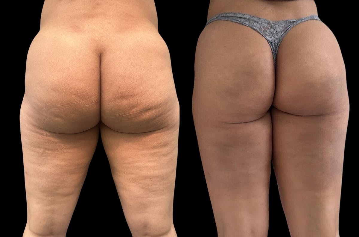 Aveli for Cellulite Before & After Gallery - Patient 202094 - Image 1