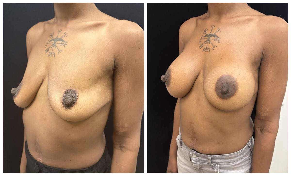  Breast Augmentation Before & After Gallery - Patient 367659 - Image 4