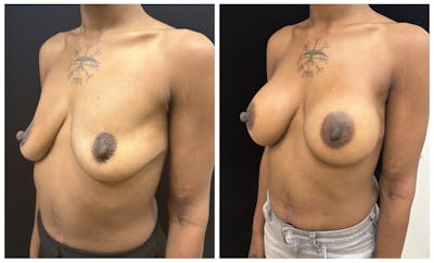 Breast Augmentation Before & After Gallery - Patient 367659 - Image 4
