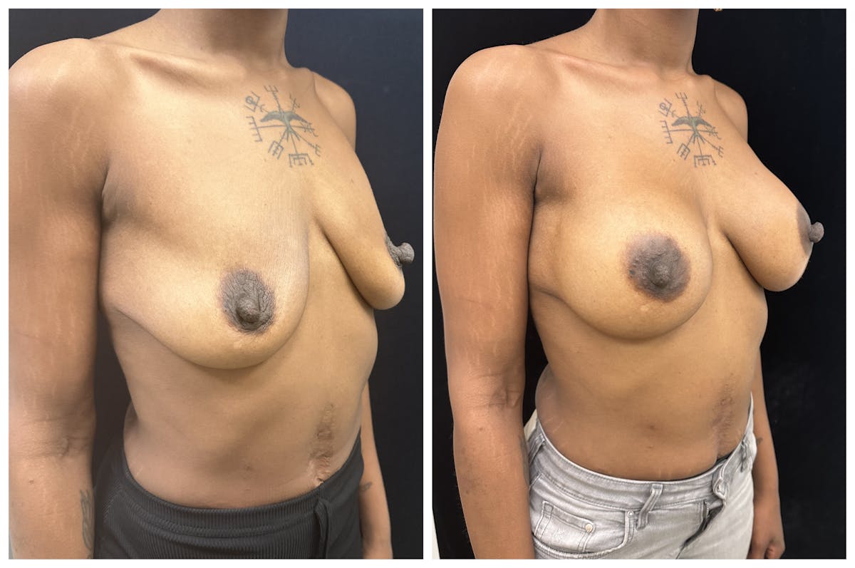  Breast Augmentation Before & After Gallery - Patient 367659 - Image 2