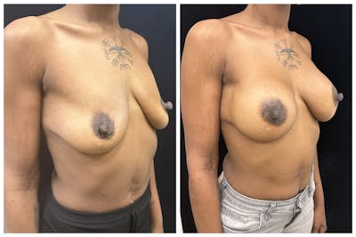 Breast Augmentation Before & After Gallery - Patient 367659 - Image 2