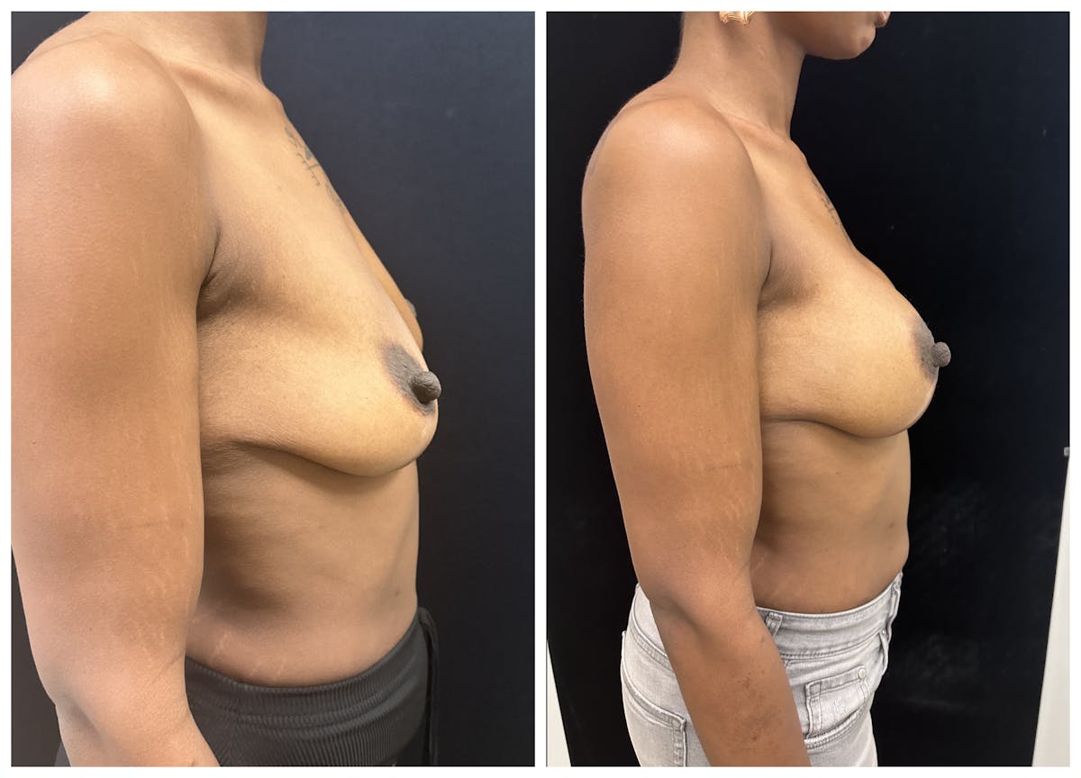  Breast Augmentation Before & After Gallery - Patient 367659 - Image 3