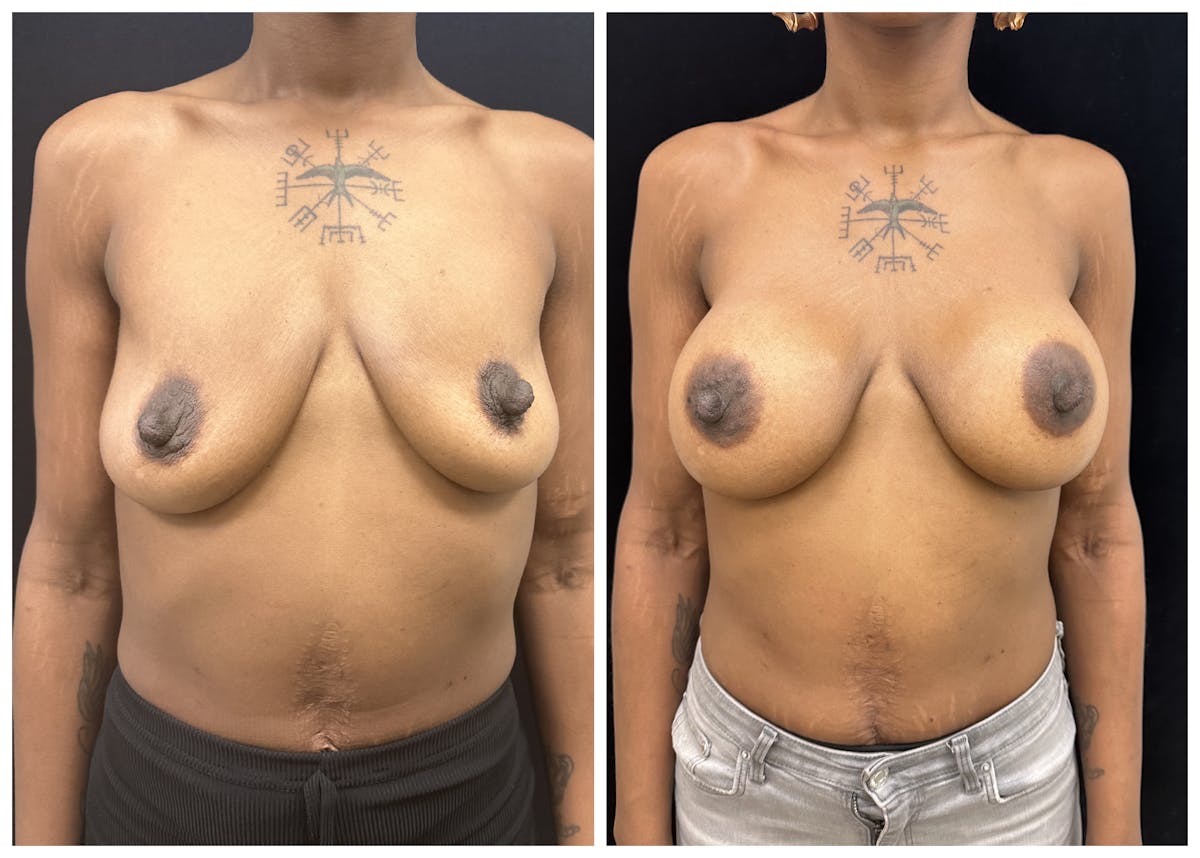  Breast Augmentation Before & After Gallery - Patient 367659 - Image 1
