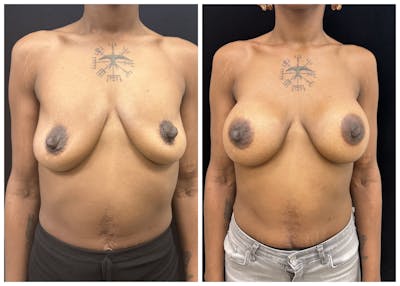 Breast Augmentation Before & After Gallery - Patient 367659 - Image 1