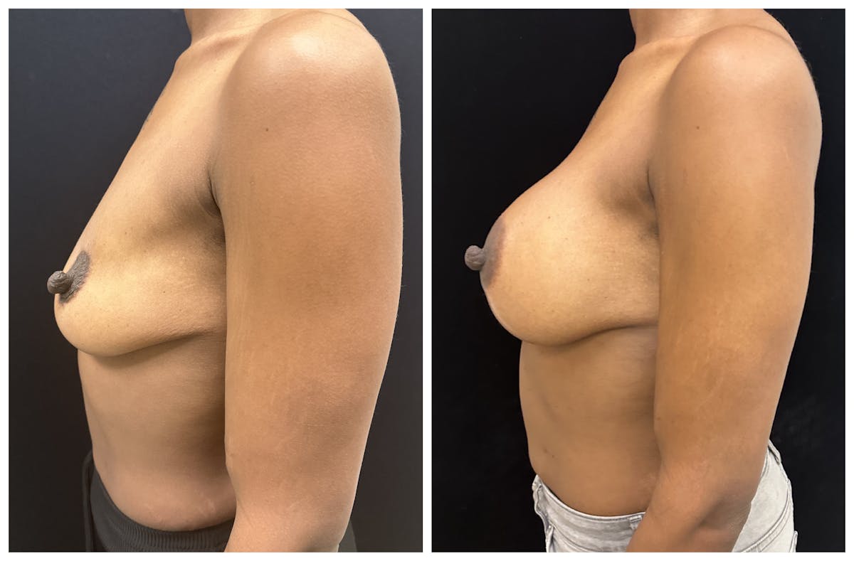  Breast Augmentation Before & After Gallery - Patient 367659 - Image 5