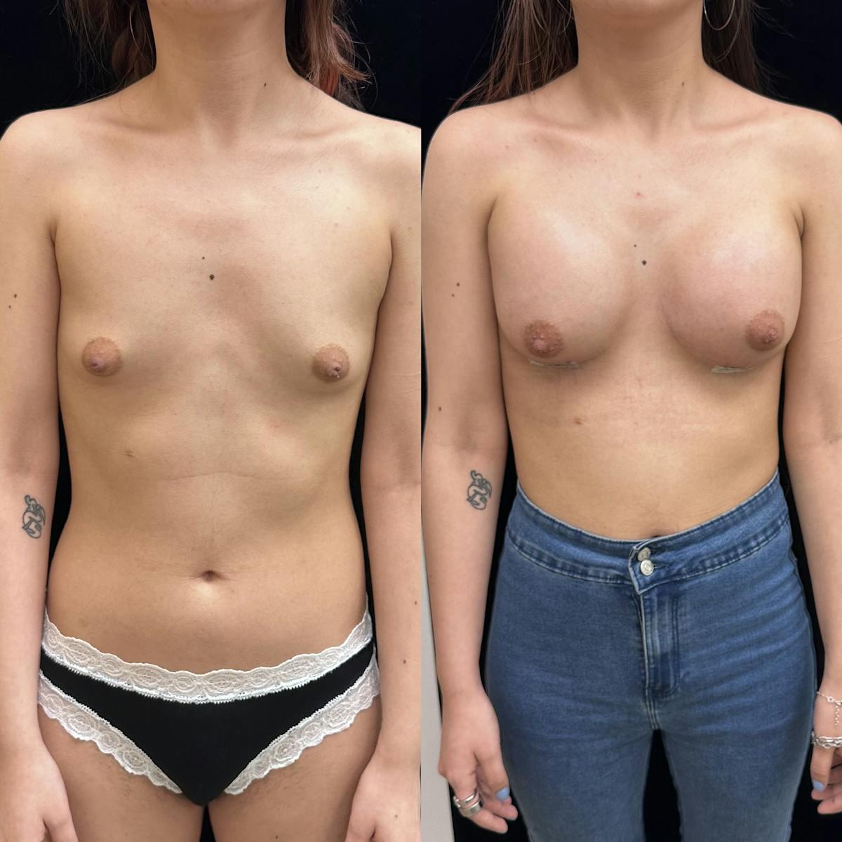  Breast Augmentation Before & After Gallery - Patient 217225 - Image 1