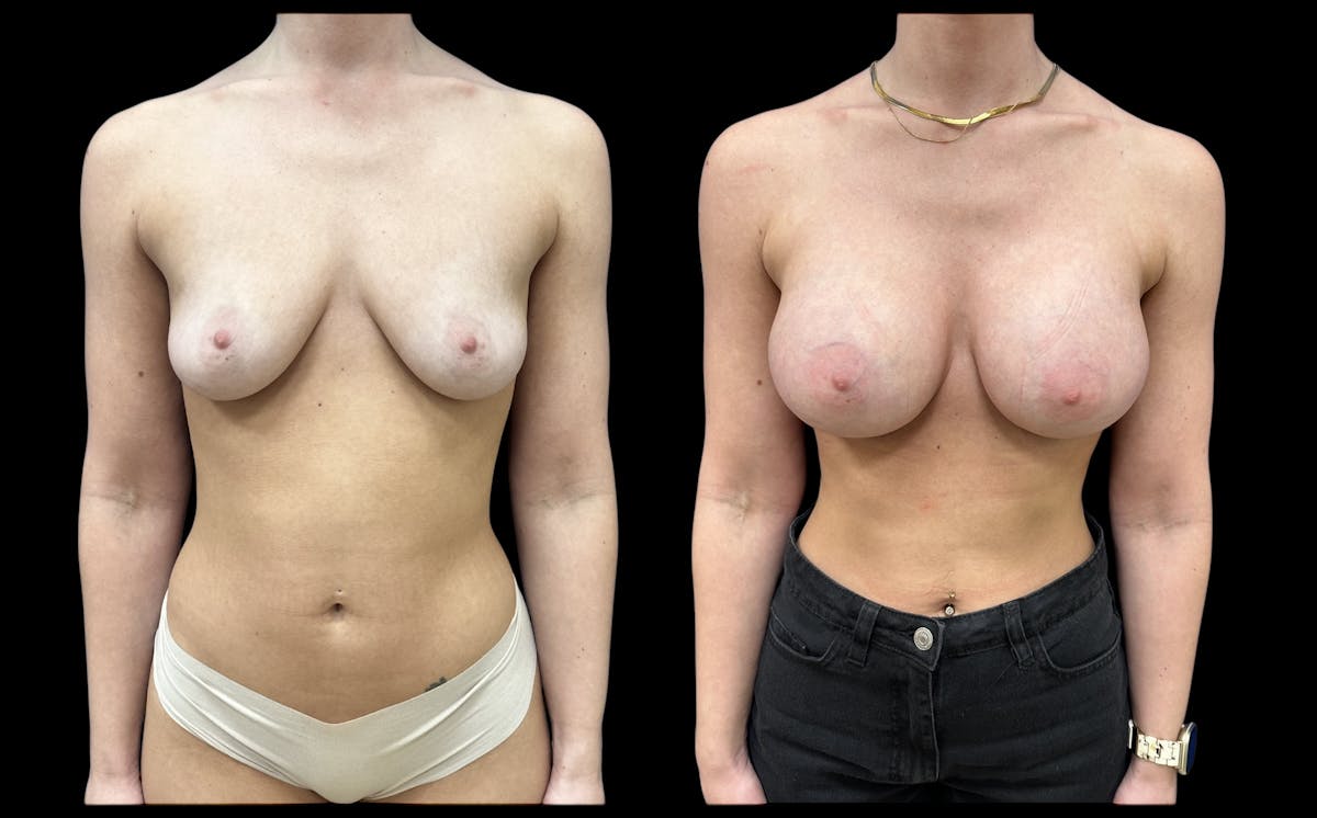  Breast Augmentation Before & After Gallery - Patient 147902 - Image 1