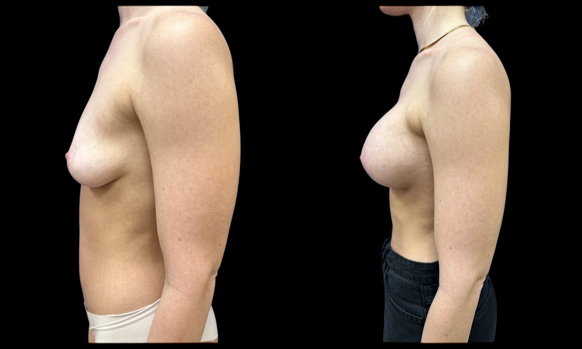  Breast Augmentation Before & After Gallery - Patient 147902 - Image 5