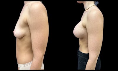 Breast Augmentation Before & After Gallery - Patient 147902 - Image 5