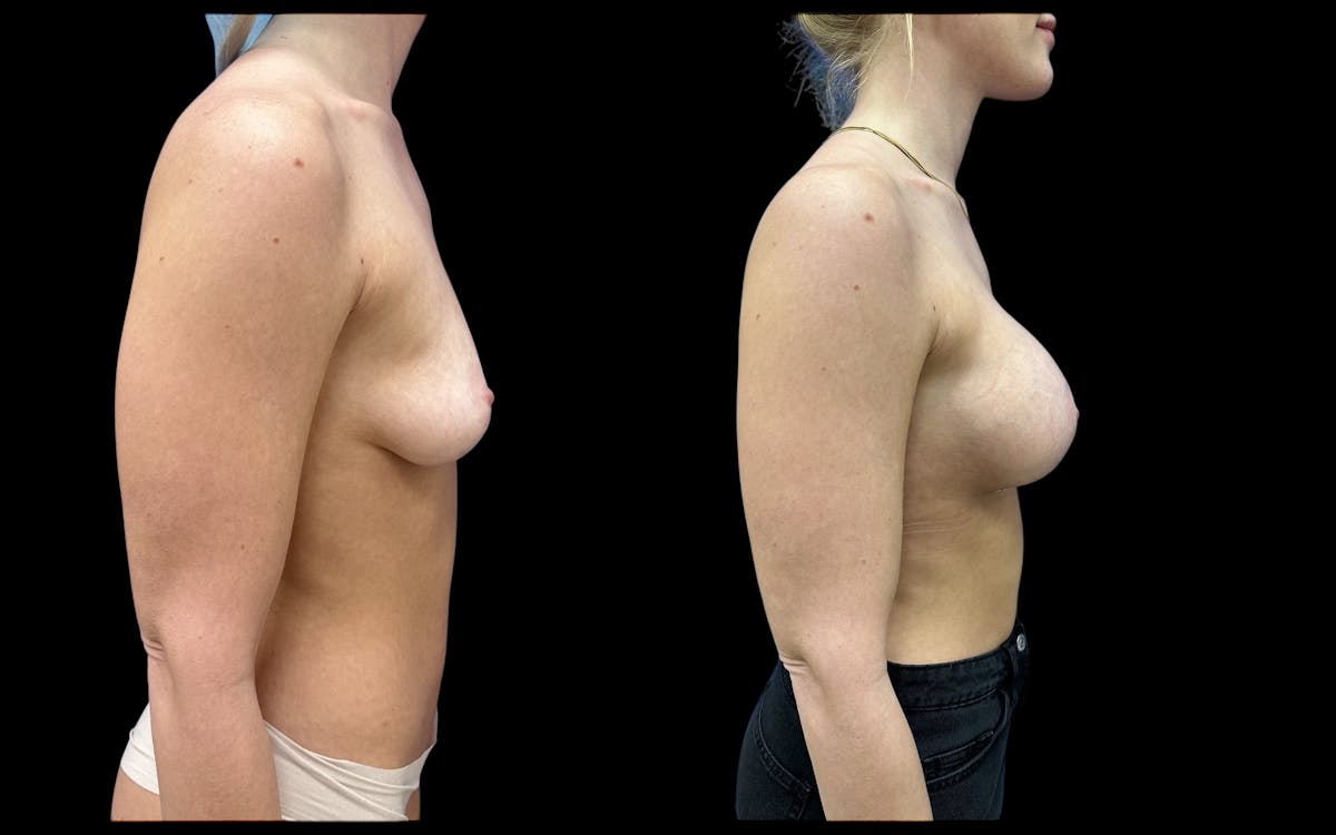  Breast Augmentation Before & After Gallery - Patient 147902 - Image 3