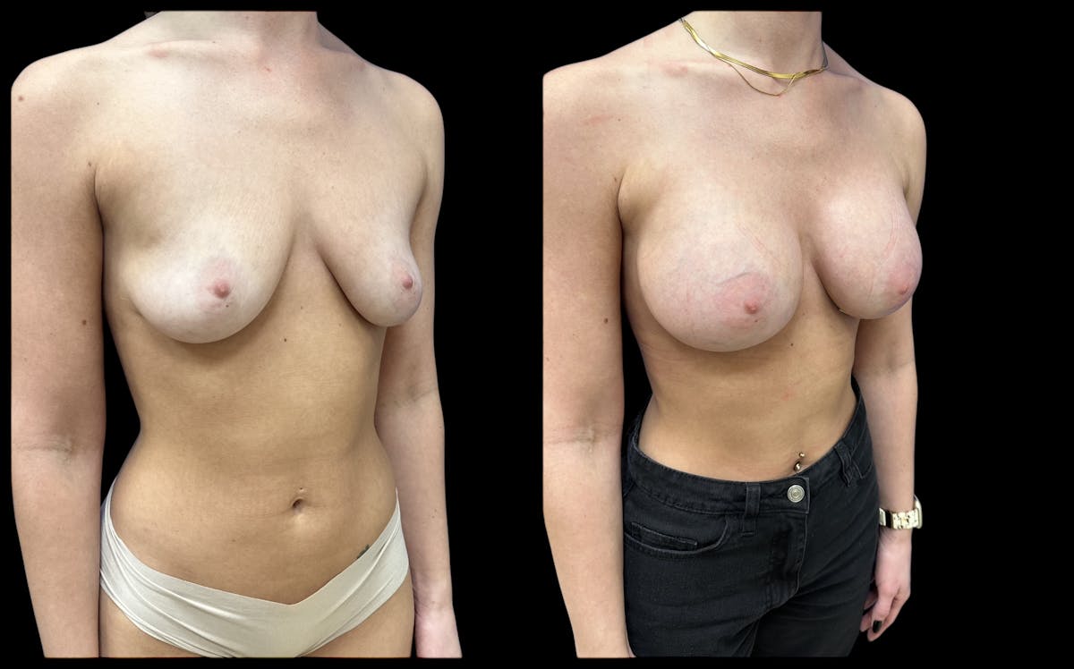  Breast Augmentation Before & After Gallery - Patient 147902 - Image 2