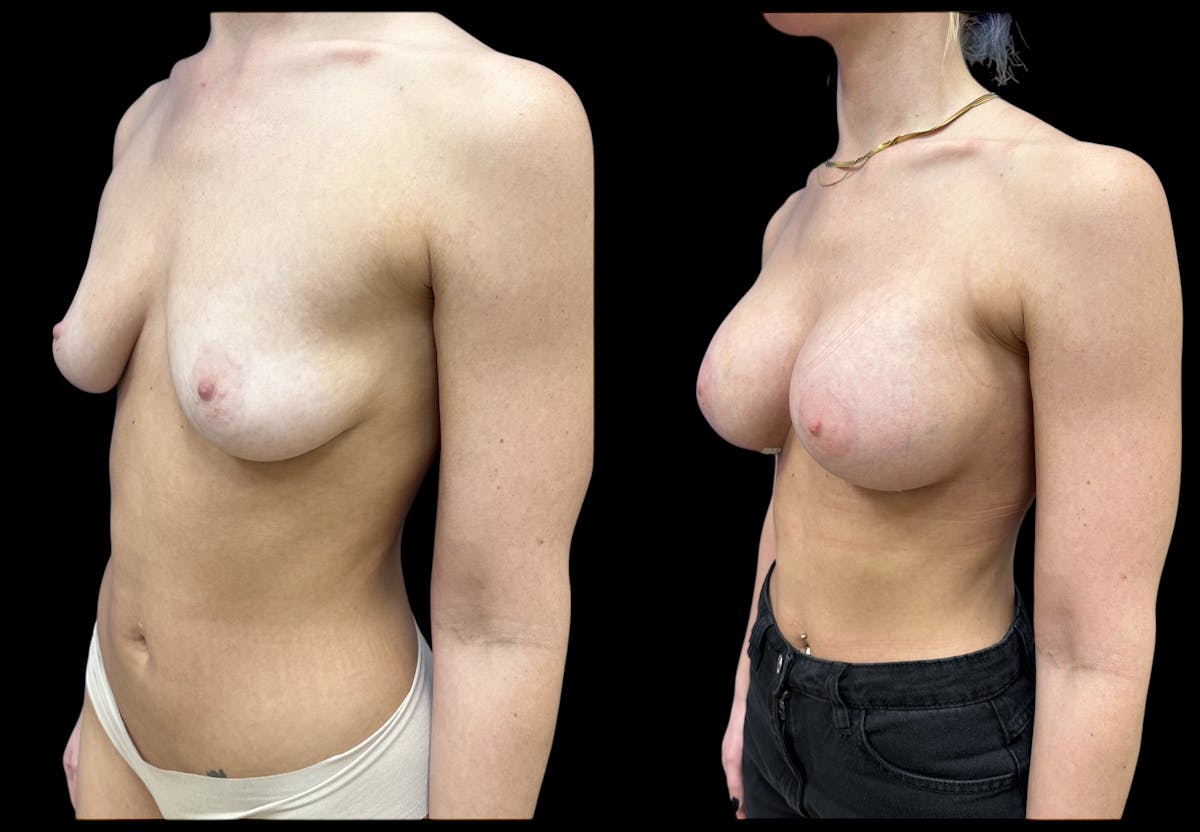  Breast Augmentation Before & After Gallery - Patient 147902 - Image 4