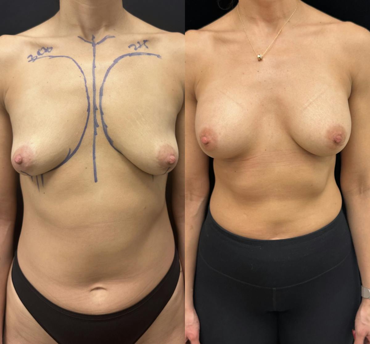  Breast Augmentation Before & After Gallery - Patient 220186 - Image 1
