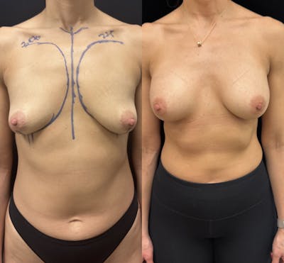 Breast Augmentation Before & After Gallery - Patient 220186 - Image 1