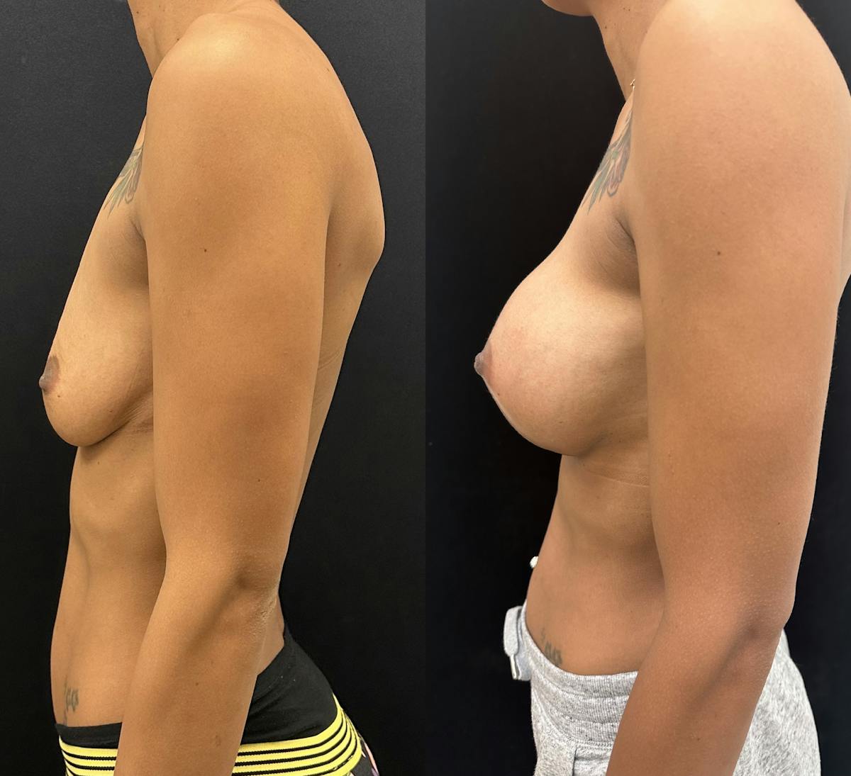 Breast Augmentation Before & After Gallery - Patient 302118 - Image 5