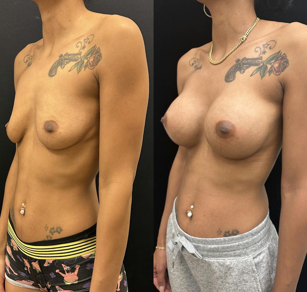  Breast Augmentation Before & After Gallery - Patient 302118 - Image 4