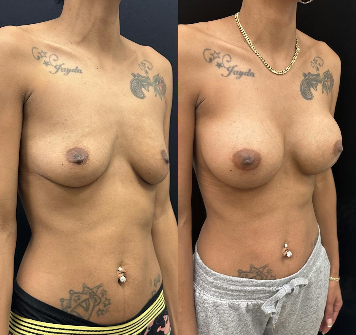  Breast Augmentation Before & After Gallery - Patient 302118 - Image 2
