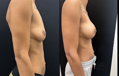Breast Augmentation Before & After Gallery - Patient 302118 - Image 3