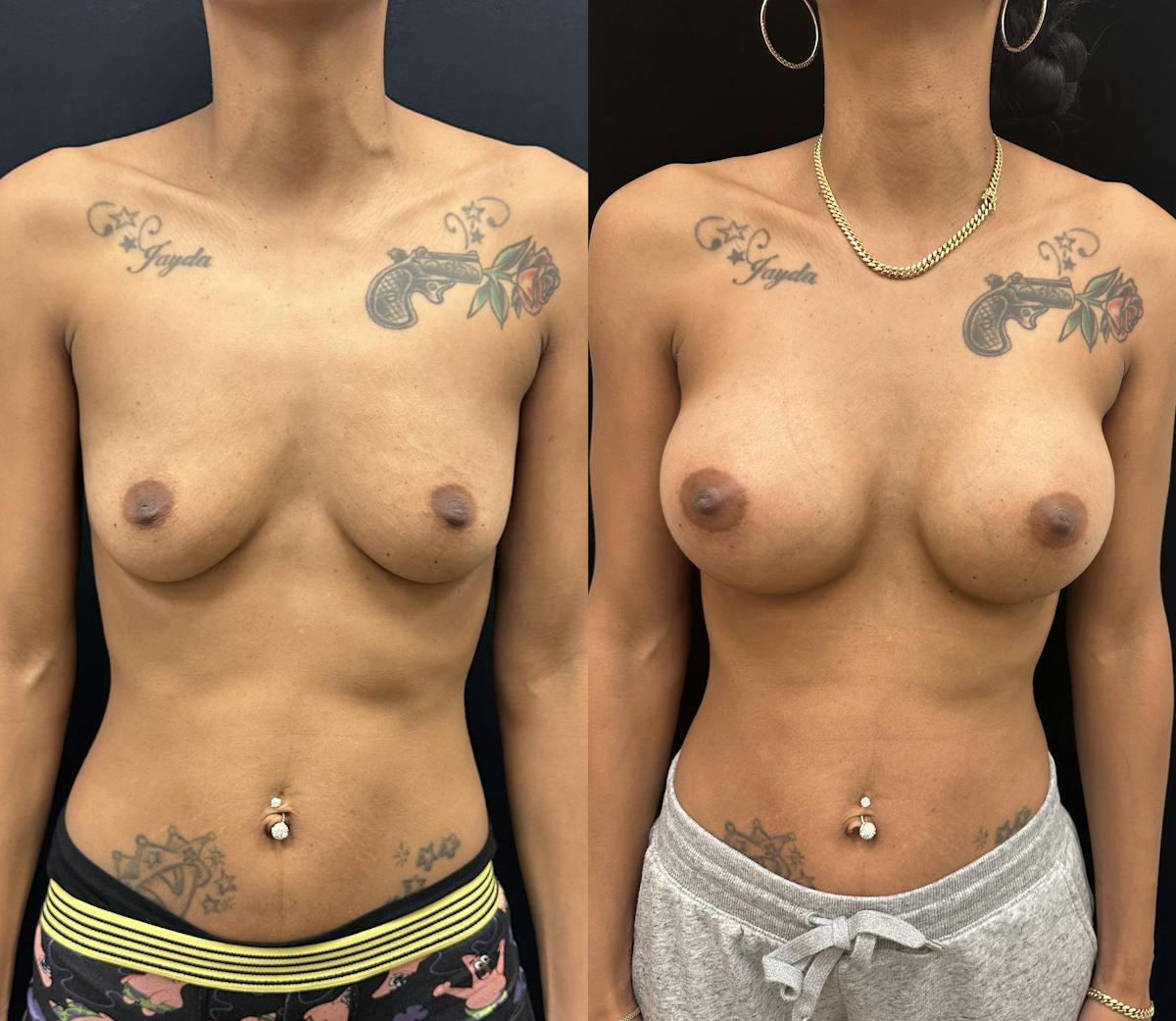  Breast Augmentation Before & After Gallery - Patient 302118 - Image 1