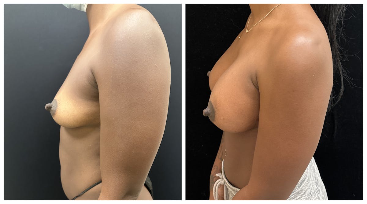  Breast Augmentation Before & After Gallery - Patient 649249 - Image 5