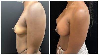 Breast Augmentation Before & After Gallery - Patient 649249 - Image 5