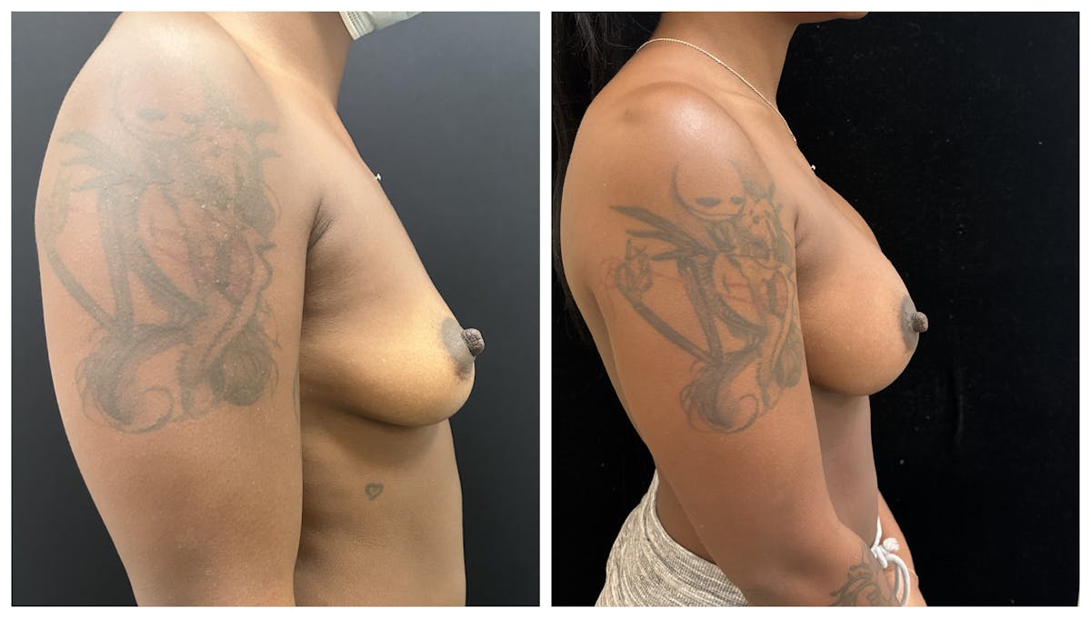  Breast Augmentation Before & After Gallery - Patient 649249 - Image 3