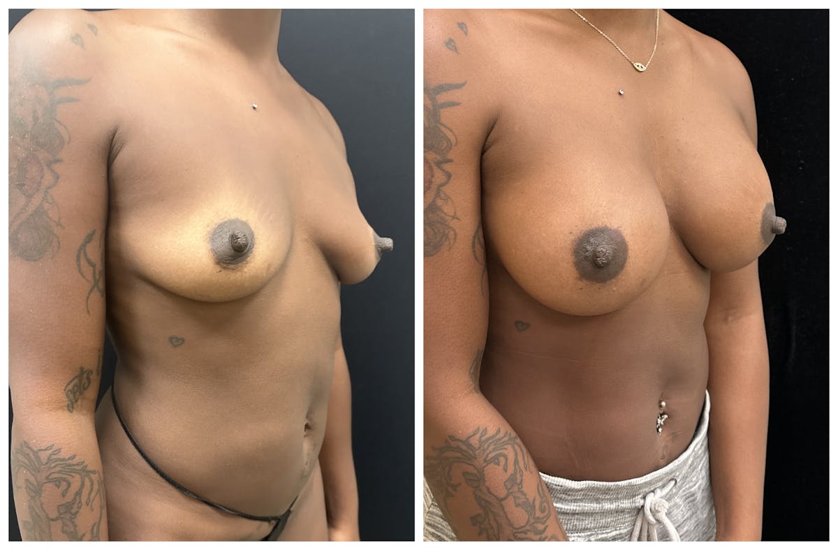  Breast Augmentation Before & After Gallery - Patient 649249 - Image 2
