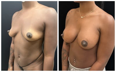 Breast Augmentation Before & After Gallery - Patient 649249 - Image 4