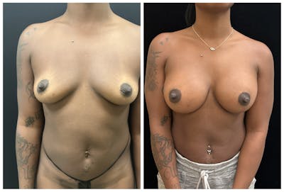 Breast Augmentation Before & After Gallery - Patient 649249 - Image 1
