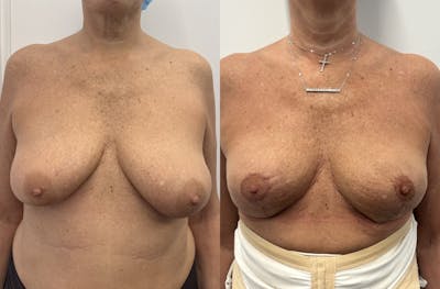 Breast Lift Before & After Gallery - Patient 142279 - Image 1