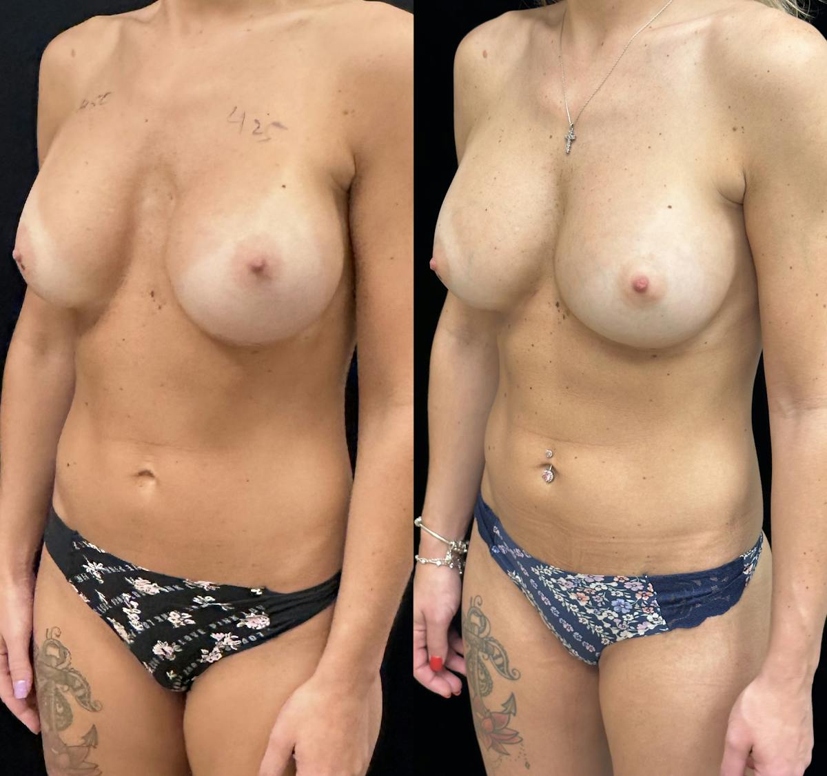  Breast Revision Surgery Before & After Gallery - Patient 417759 - Image 2